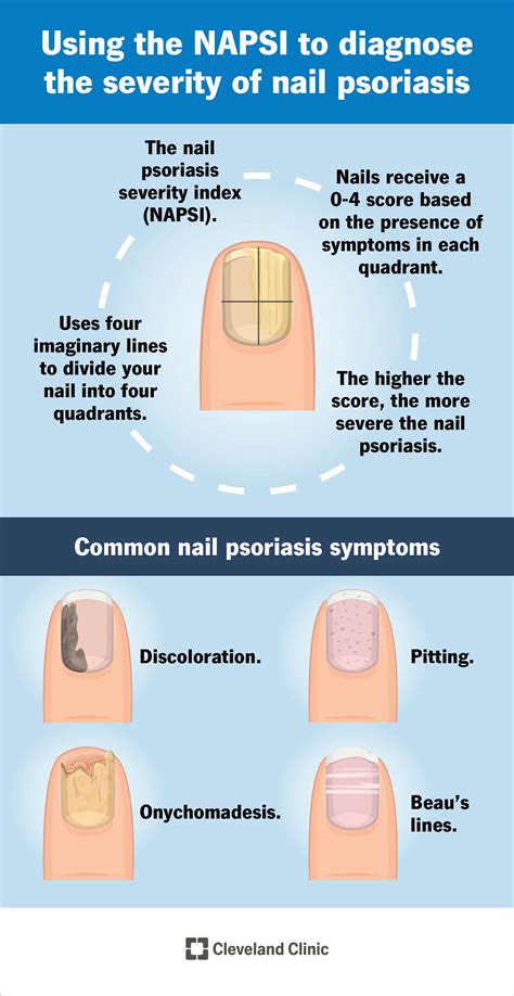 Nail Psoriasis: What It Is, Causes, Nail Pitting, Treatment, 53% OFF