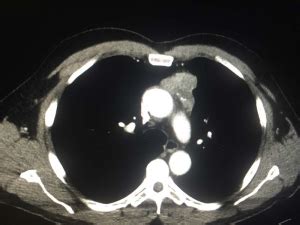 Anterior Mediastinal Mass On CT – Radiology In Plain English