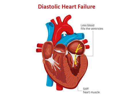 Know The Symptoms of Diastolic Dysfunction | Dr. Raghu