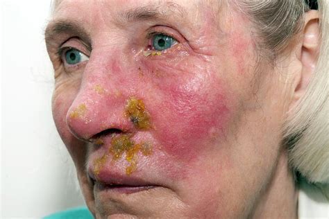 Shingles Rash On The Face Photograph by Dr P. Marazzi/science Photo Library