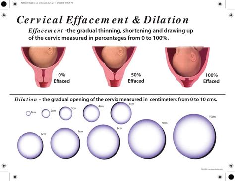 Cervical Effacement Dilation | Cervical effacement, Cervix, Cervix dilation