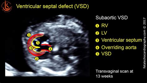 Ventricular Septal Defect Ultrasound