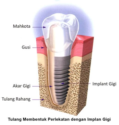 Dental Implant Mengganti Gigi yang Patah Hilang | Cara Membuat Resep Cantik