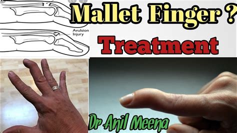 mallet finger treatment | mallet finger treatment at home | mallet ...