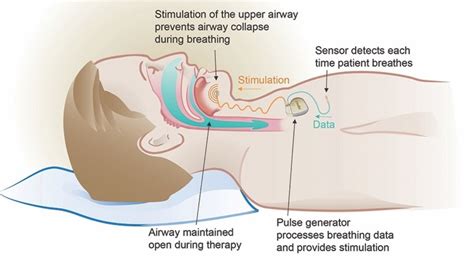 inspire sleep apnea doctors near me - Vita Samuels