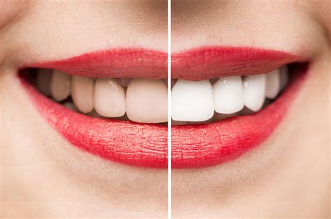 Teeth Whitening | Lister House Dental Centre | Essex Dentist