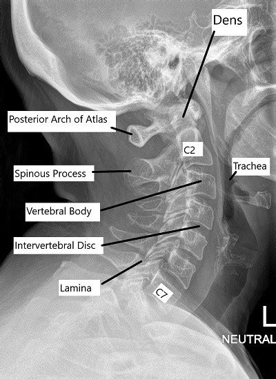 Anatomy of the Spine - Complete Orthopedics & Podiatry | Multiple NY ...