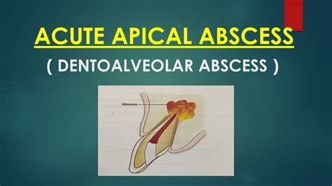 Acute Apical Abscess ( Endodontics) - YouTube