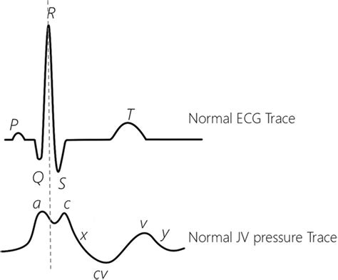 Jugular Venous Pressure Waveform