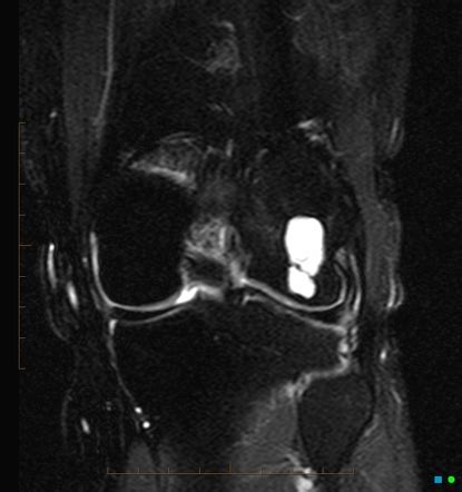 Subchondral Cyst