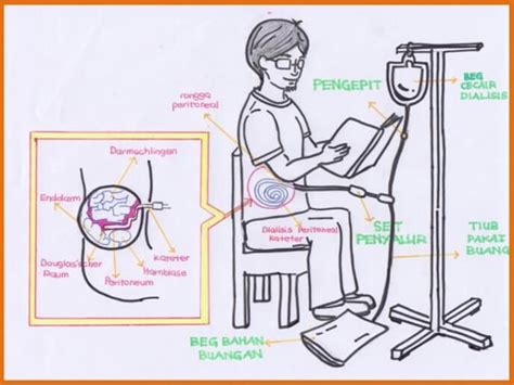 Comprehensive Guide to Peritoneal Dialysis: Procedure, Benefits, and ...