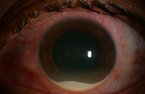 Moran CORE | Bacterial Corneal Ulcer