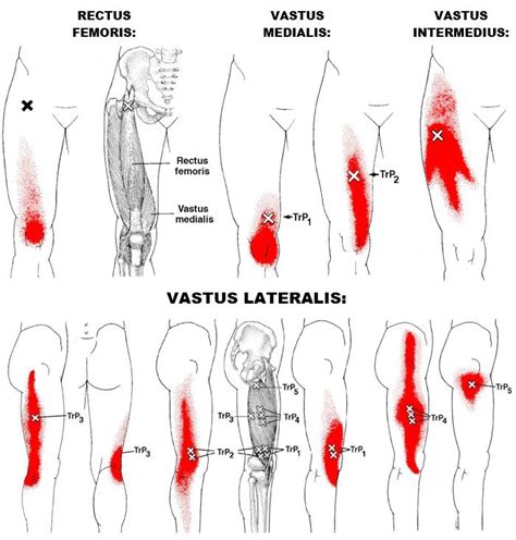 Vastus Medialis Pain