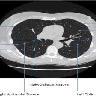 Workflow of lung oblique fissure segmentation | Download Scientific Diagram