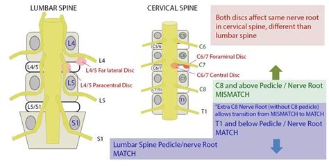 Cervical-Lumbar Vertebrae Diferences | Lumbar disc, Disk herniation ...