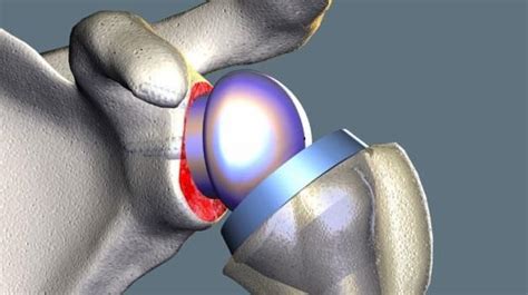 Shoulder Arthritis- What is Shoulder Arthroplasty?: William Schell, MD ...