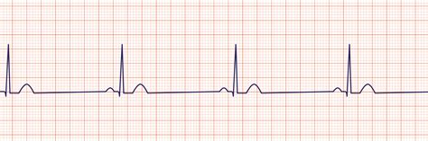 ECG INTERPRETATION FOR NCLEX: PART THREE - The Nurse Speak