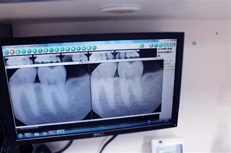 Apical periodontitis: symptoms, diagnosis, treatment | Dentistry 2024