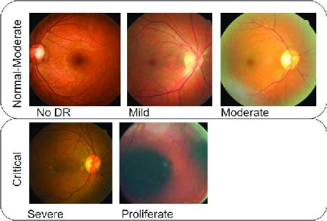 The 5 diabetic retinopathy stages, ranked by severity [7]. | Download ...