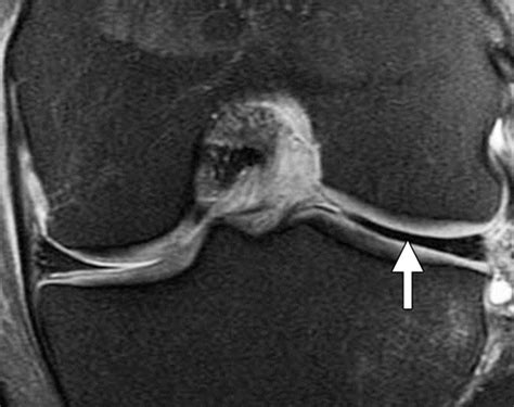 MR Imaging–based Diagnosis and Classification of Meniscal Tears