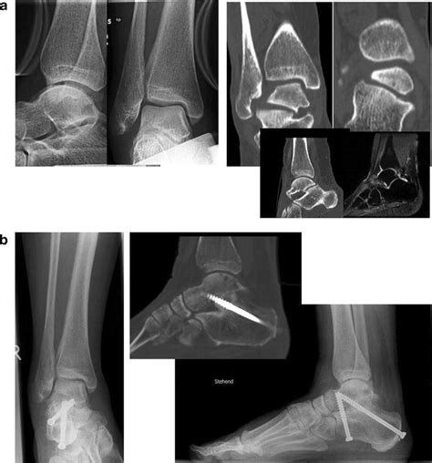 a Combined ankle instability and subtalar joint osteoarthritis with ...