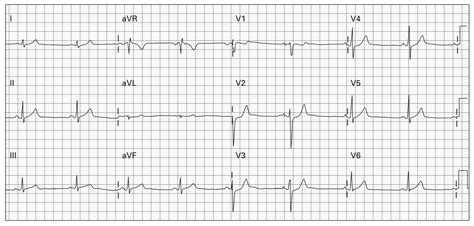 Posterior MI Recognition - emdocs