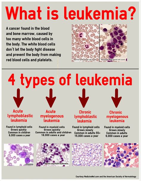 LEUKEMIA: CAUSES , SYMPTOMS, AND TREATMENT