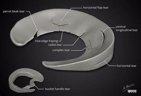 Different Types of Meniscal Tears