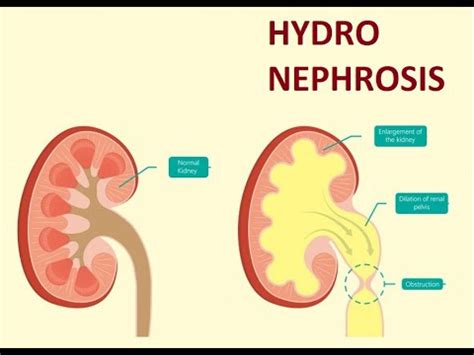 Surgery 945 Hydronephrosis Case Viva Questions Clinics History ...