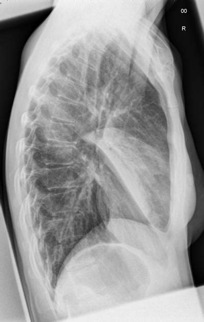 Lobar Pneumonia vs Bronchopneumonia - eHealthStar