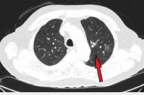 Postoperative CT demonstrating lung metastases. Non-contrast CT, axial ...