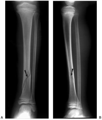 Nondisplaced Spiral Fracture Fibula / Fibula Fracture: Types, Treatment ...