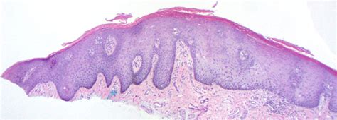 Labial Lentigo (labial melanotic macule)