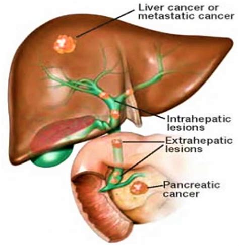 oportunidad hidrógeno este blocked bile duct treatment Lima Porra Espantar