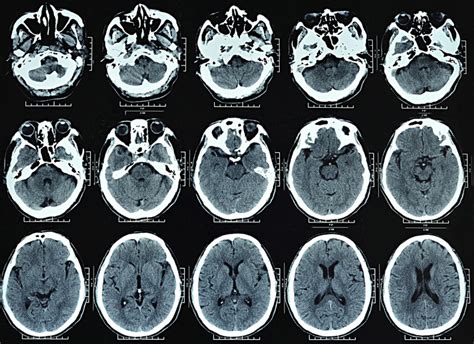 What is a brain CT scan? | Two Views