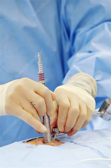 Slipped disc microendoscopy surgery - Stock Image - C004/9398 - Science ...