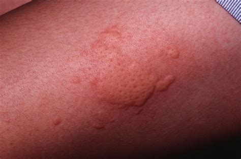 Chronic Hives - Causes, Symptoms, and Treatment