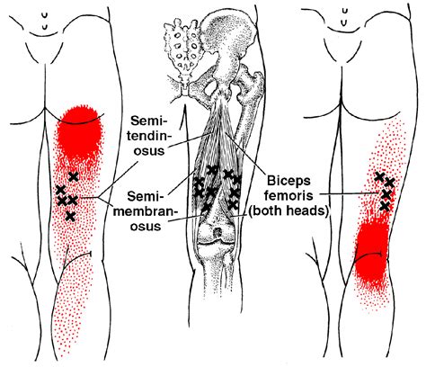 Biceps Femoris, Semitendinosus, Semimembranosus • Rehab Renegade