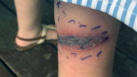 This Girl's 'Bruise' Was Actually Venom From a Black Widow Spider Bite ...