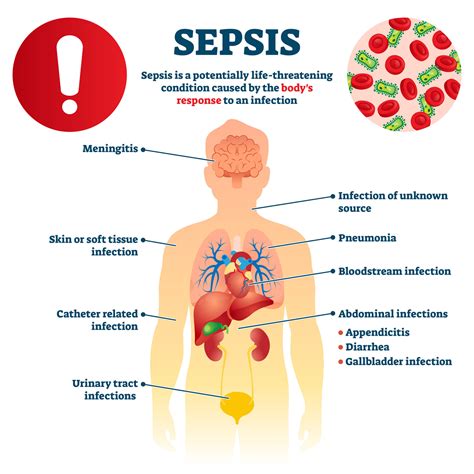 What is Sepsis?