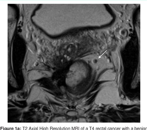 [PDF] Evaluation of Mesorectal Lymph Nodes with High-Resolution MRI ...