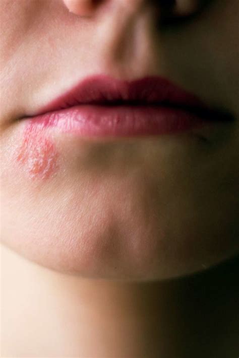 Shingles: Symptoms, pictures, treatments, and more