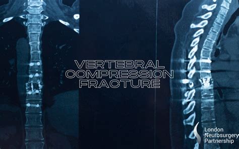 Vertebral compression fracture - London Neurosurgery