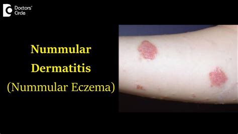 Nummular Eczema: The Facts and Tips for Prevention - Pharmacists.org