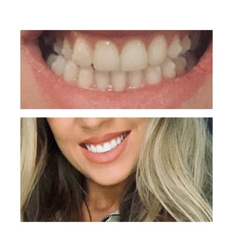 Before and after - 14 weeks and composite bonding :) Invisalign lite to ...