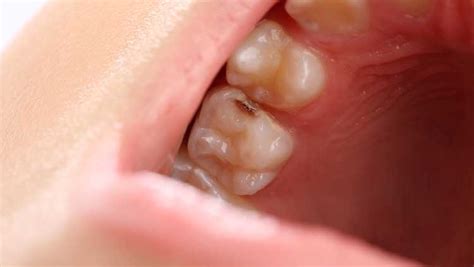 7 Common Signs and Symptoms of a Tooth Cavity | Absolute Dental