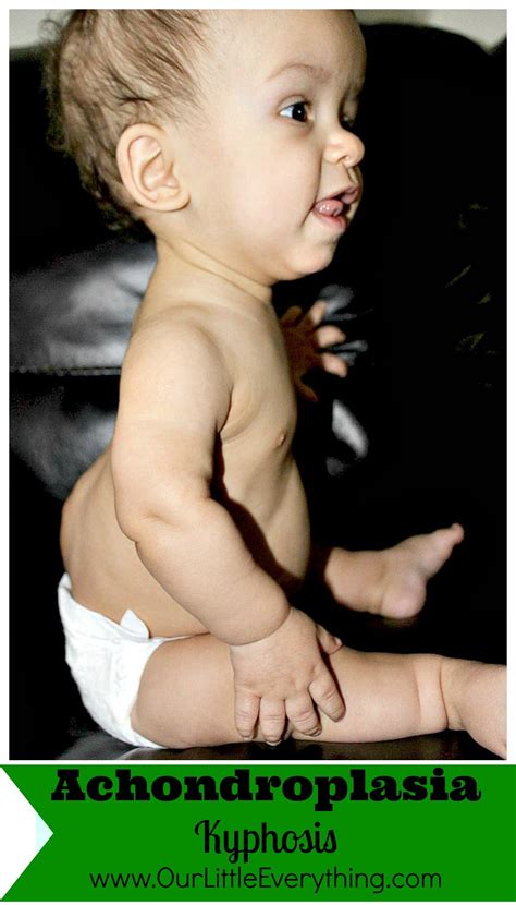 Kyphosis in Children with Achondroplasia - Delicious Little Bites