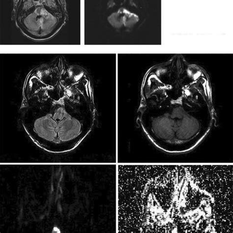 On MRI (top panel), a focal left pontine intra-axial infarct is seen as ...