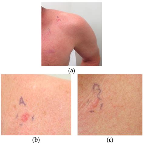 IJMS | Free Full-Text | Appearance of New Cutaneous Superficial Basal ...