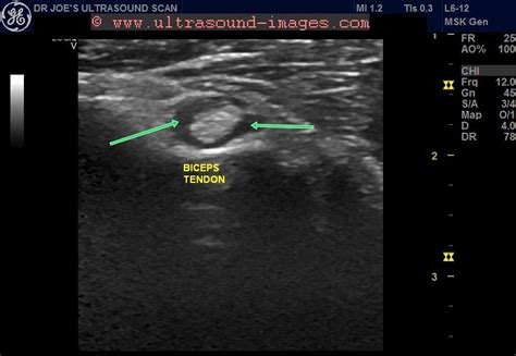 Ultrasound imaging